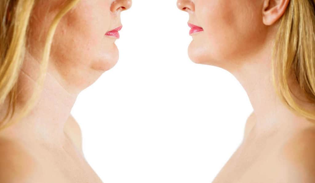 Double Chin treatment Shropshire before and after results