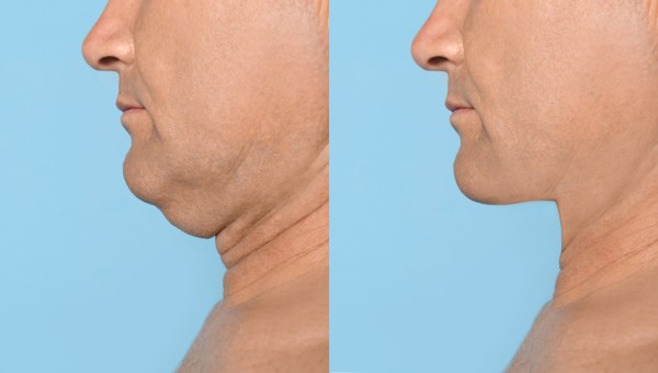 Which Non-Surgical Treatments Work Best for Jowls and Loose Skin Shropshire?