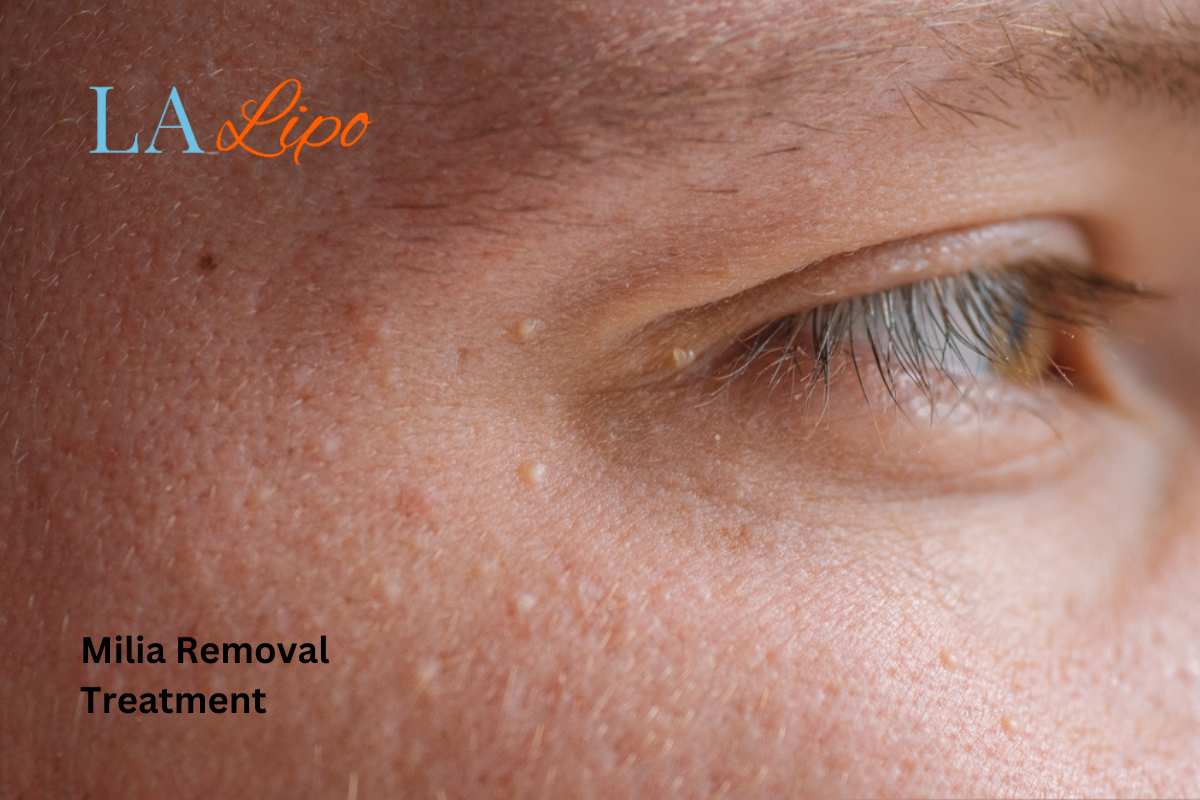 Cryopen Milia Removal: Is It the Easiest and Safest Option Shropshire?