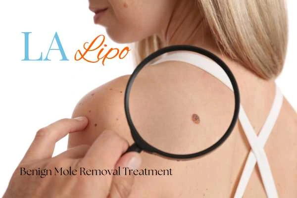 Woman having her inspection of blemish before mole removal Shropshire