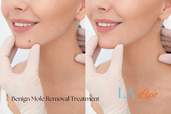 Before and after mole removal Shropshire treatment