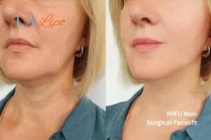 hi-fu for wrinkles Shropshire before and after results