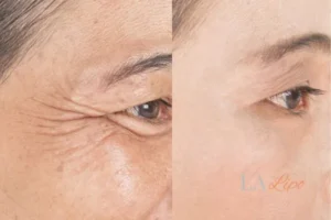Before and after results of woman - HI-fu wrinkles reduction treatment Shropshire