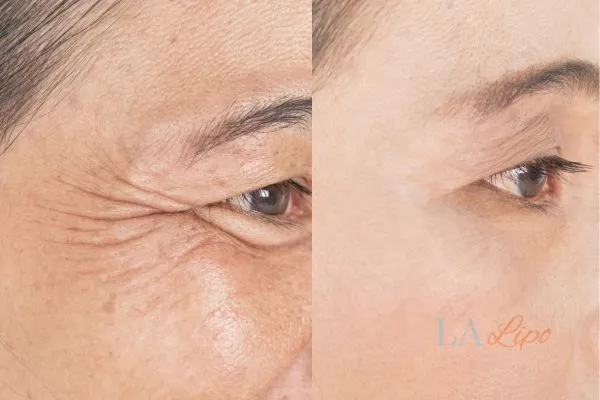 Before and after results of woman - HI-fu wrinkles reduction treatment Shropshire