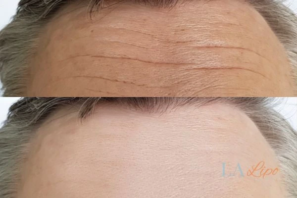 results of HIFU Shropshire on mans forehead to help reduce lines and wrinkles