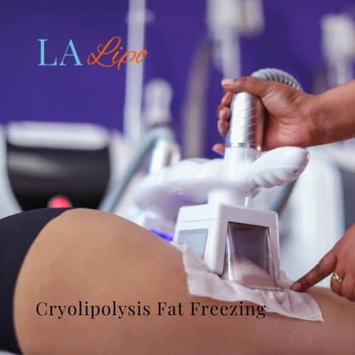 fat freezing - Cryolipolysis Shropshire