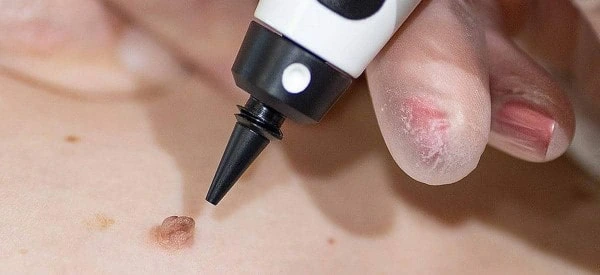 skin tag removal using cryopen Shropshire