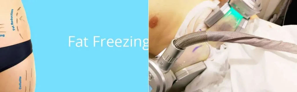 Fat freezing Shropshire on multiple areas of the body