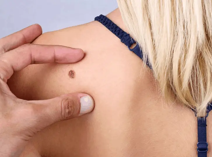 woman having mole removal Shropshire consultation before treatment.