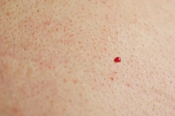 close up of a cherry angioma Shropshire