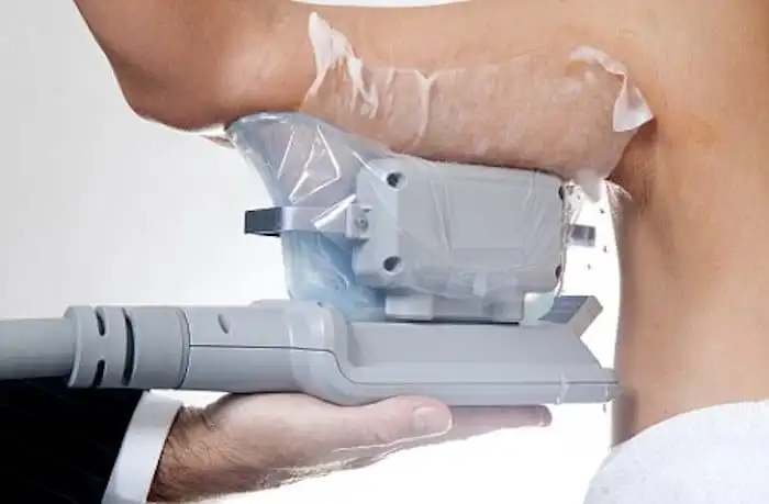 Picture of fat freezing Shropshire on the upper arms.