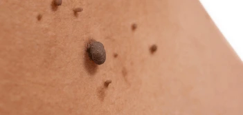 image of a skin tag Shropshire