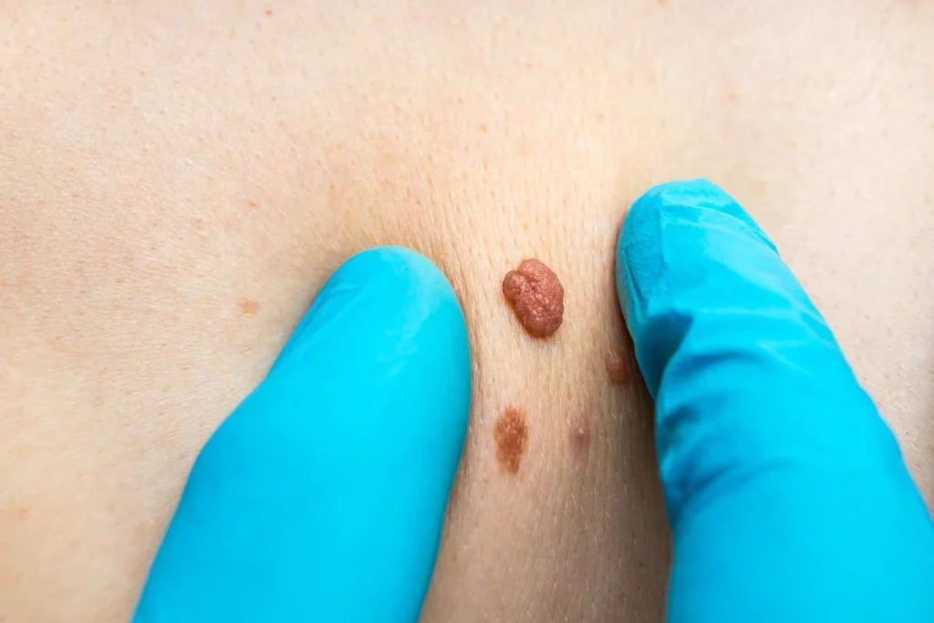 Consultant examining a skin tag Shropshire
