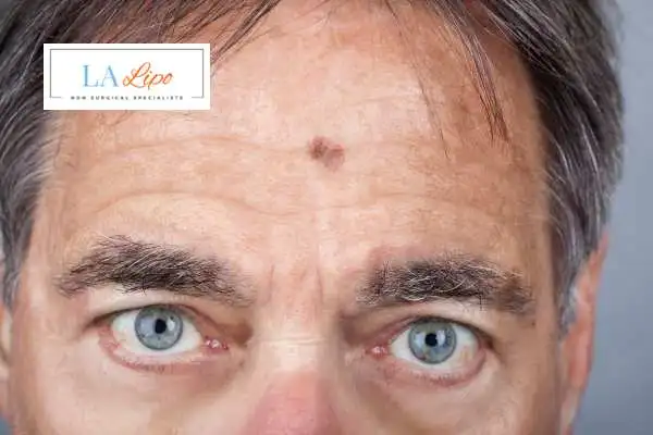 Solar Lentigo Removal Shropshire image of man with mark on his forehead