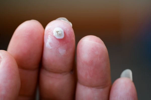 wart on person finger - cryotherapy to treat from LA LIPO Shropshire