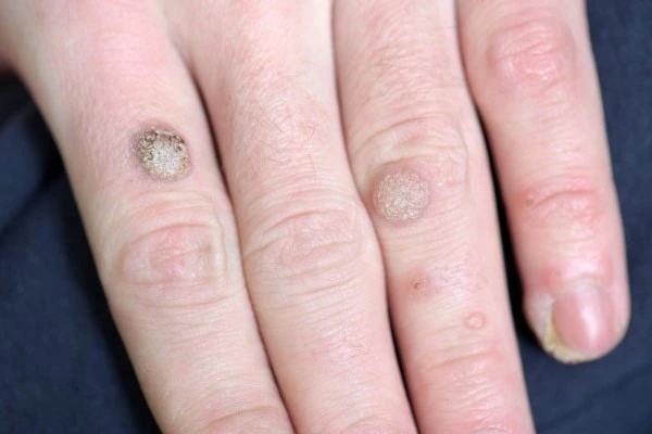 photo of warts on person hand - see wart removal Shropshire from LA LIPO