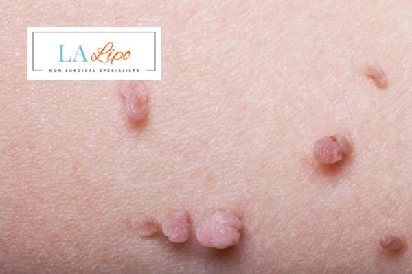 Does cryopen skin tag removal Shropshire hurt? Find out now call our team today!