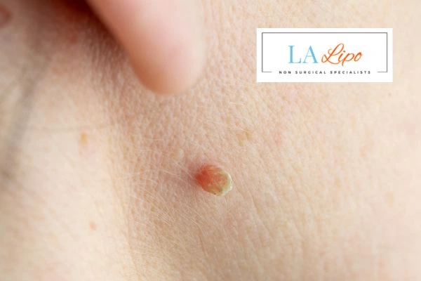 Book skin tag removal Shropshire today speak to our team now!