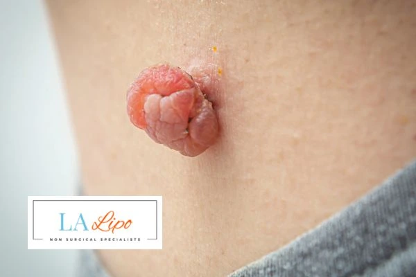 Interested in skin tag removal Shropshire? Concerned about the pain? Find out more today!