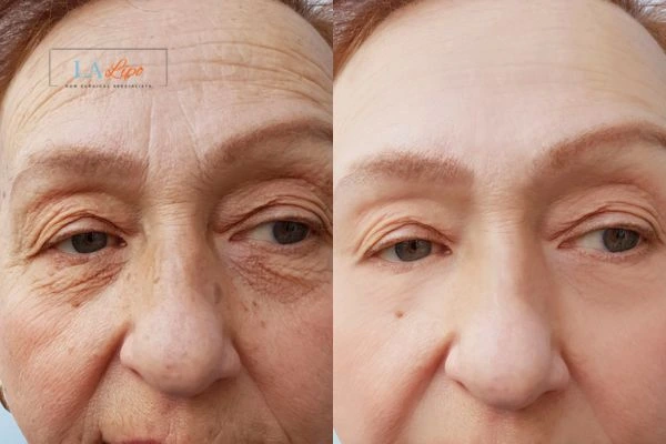 The powerful benefits of Morpheus8 Treatment Shropshire - Call Our team today!