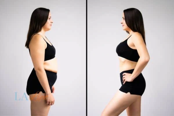 Picture of womans before and after using LA-EMS body sculpting to improve her core strength Shropshire