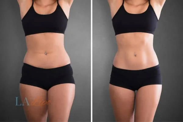 before and after results of non-surgical treatment to help a woman's body image and mental health Shropshire