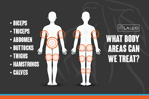 Diagram to show areas you can have LA-EMS Body Sculpting Treatment Shropshire