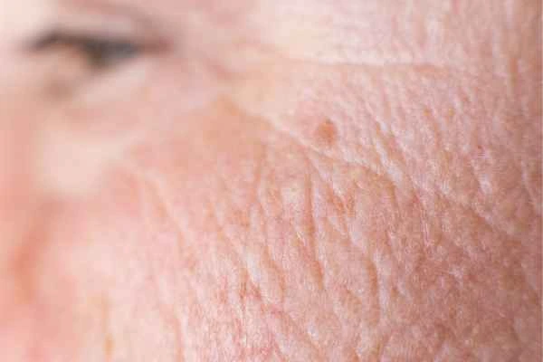close up picture of a woman's face showing an age spot Shropshire