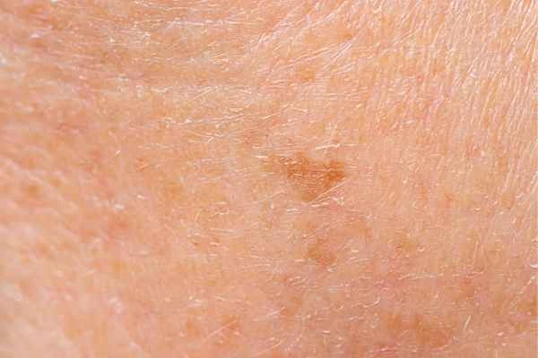 close up picture of age spots Shropshire