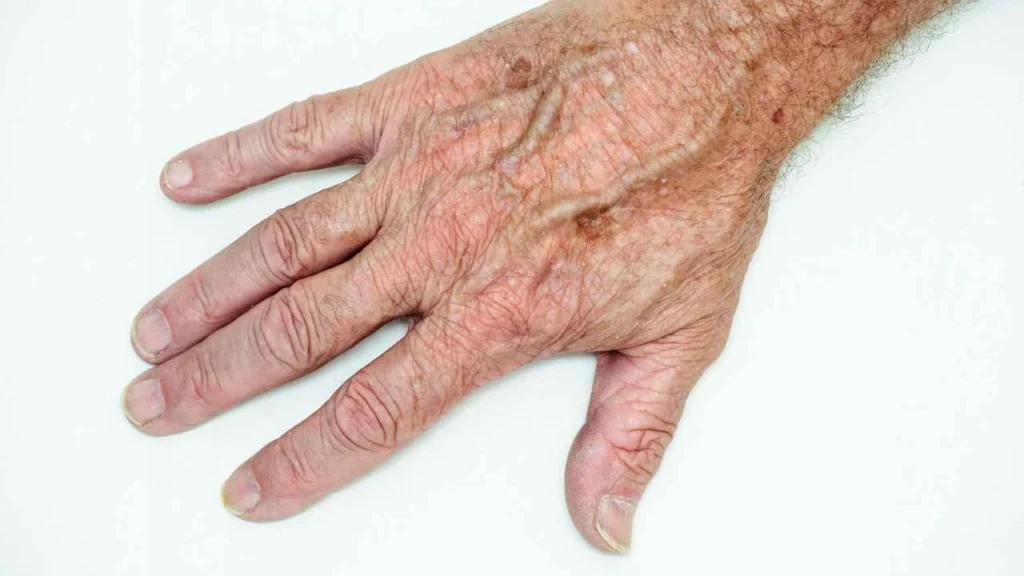 Male hand showing age spot Shropshire