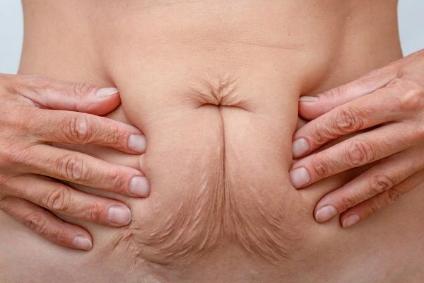 Image of a woman's stomach with loose skin - example of skin tightening Shropshire options