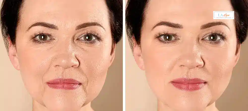 How Long Does It Take to See Results and How Long Do They Last Shropshire?